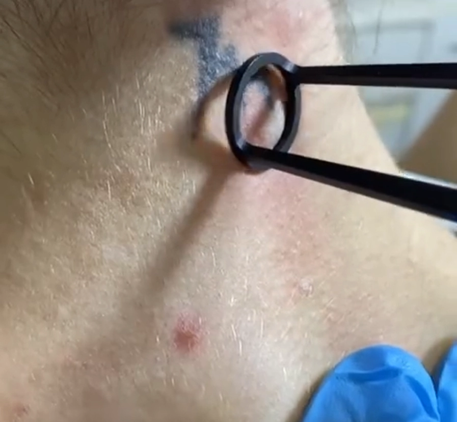 Remoção de Tatuagens